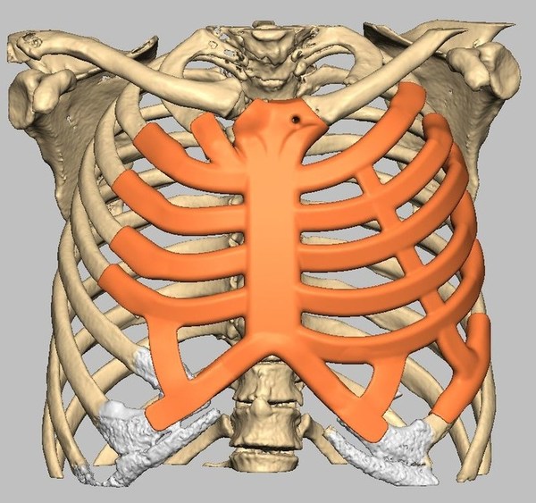 計劃採用AnatomicsRx C3D軟件進行大規模胸腔重建。